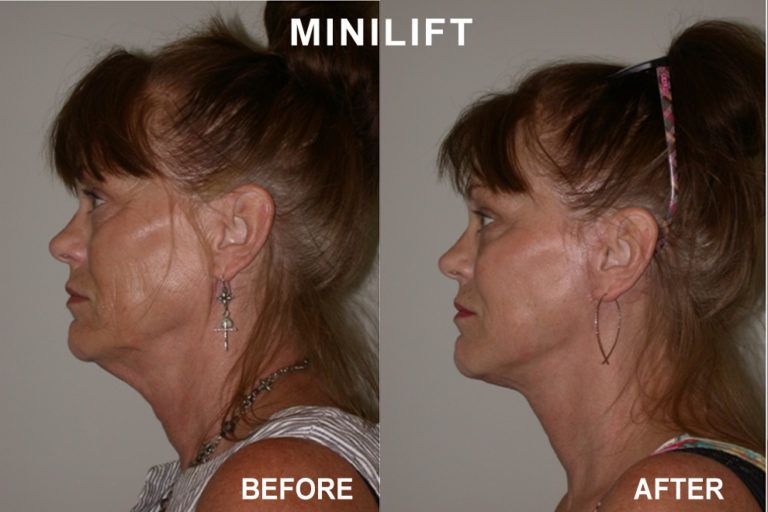 Comparison of a woman's profile before and after a minilift, showing a reduction in neck and jawline sagging.