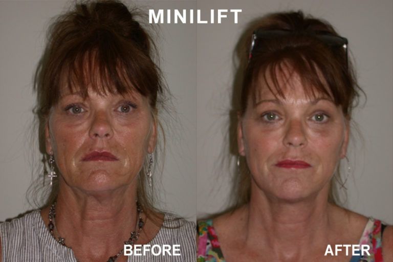 Side-by-side comparison shows a woman before and after a minilift facial procedure, with less sagging skin.