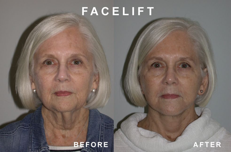 Before and after images of a woman's face, showing the effects of a facelift.