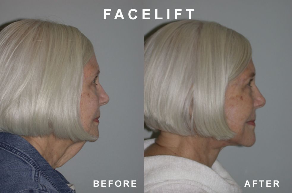 Facelift comparison: woman's profile before and after surgery, showing reduced neck and face sagging.