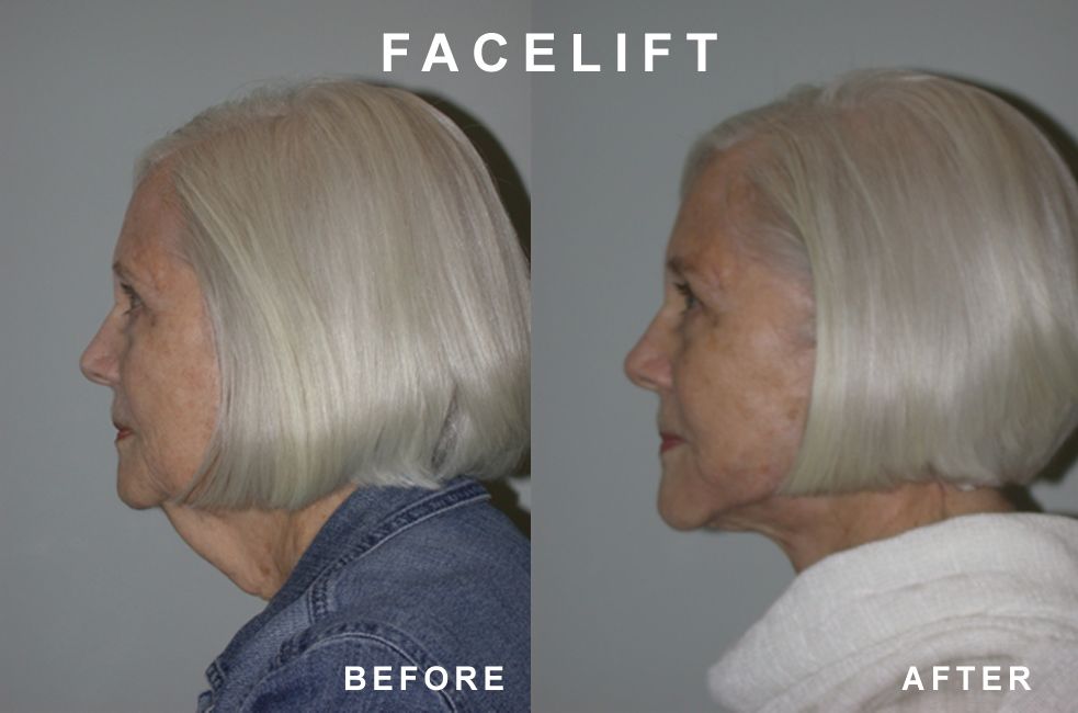 Side-by-side photos comparing a woman's face before and after a facelift procedure, showing reduced sagging skin.