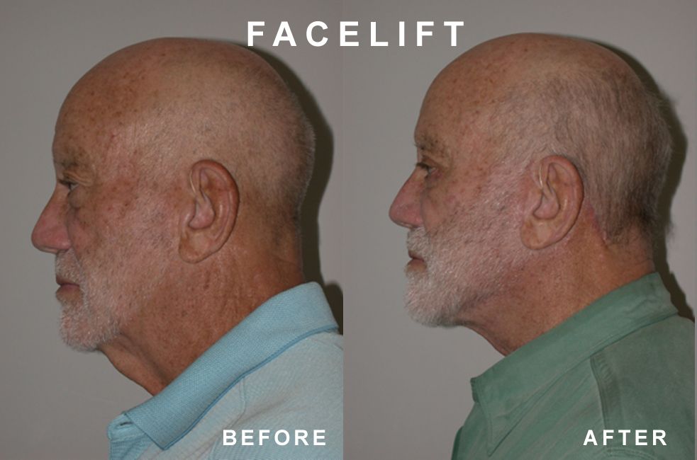 Side-by-side photos comparing a woman's face before and after a facelift procedure, showing reduced sagging skin.