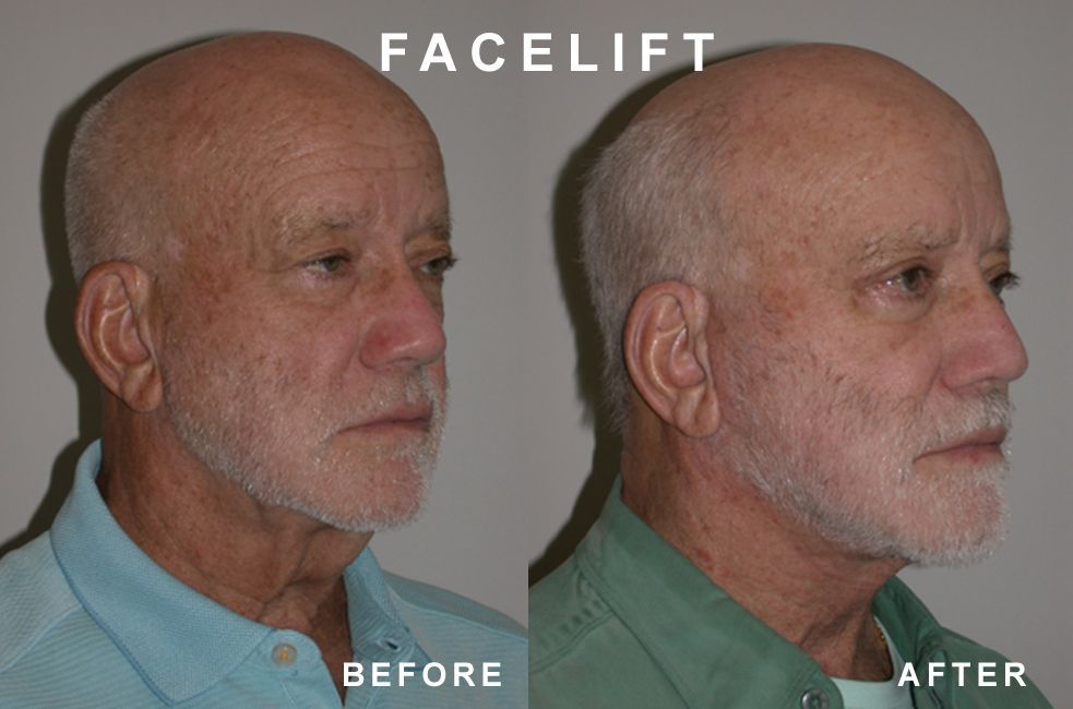 Facelift comparison: Man's profile before and after surgery. Skin appears tighter, less sagging.