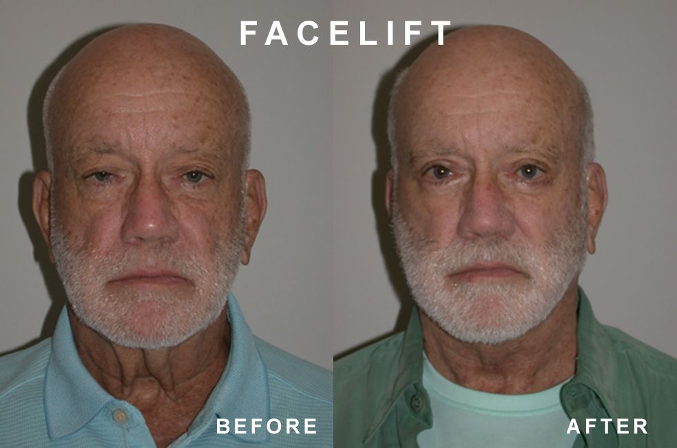 Side-by-side comparison of a man's face before and after a facelift. The 