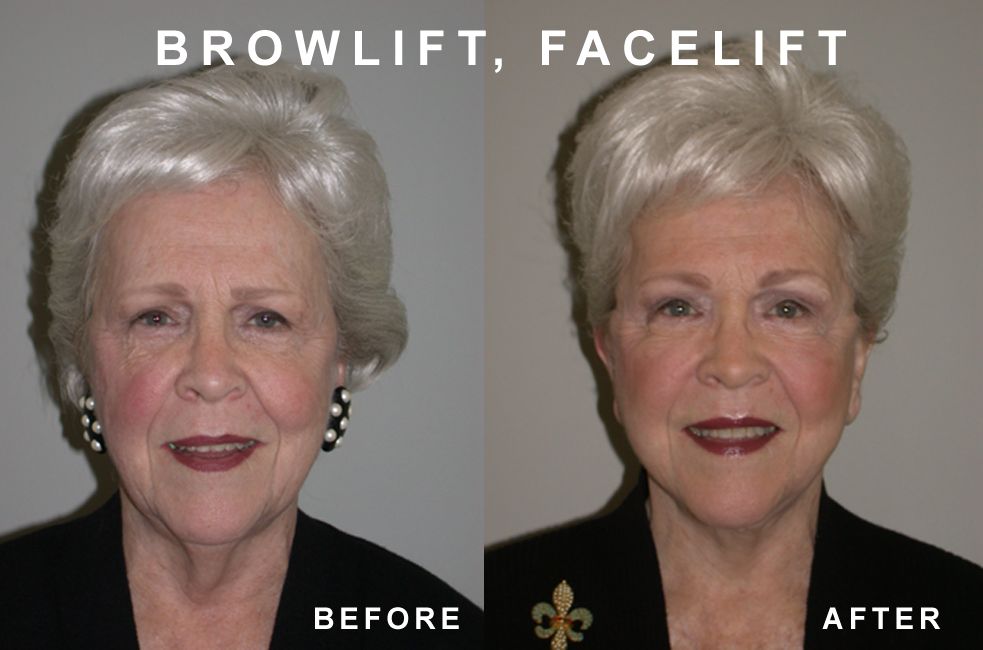 Before-and-after of a woman's face. Brow lift and facelift result. Dark hair, red lips, and slightly flushed skin.
