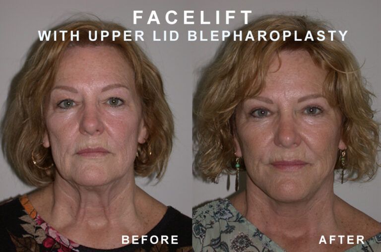 Before-and-after of a woman after facelift and upper eyelid surgery. The 