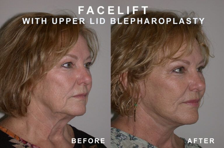 Side-by-side comparison: woman's face before and after facelift and upper eyelid surgery; showing tighter skin, less droop.