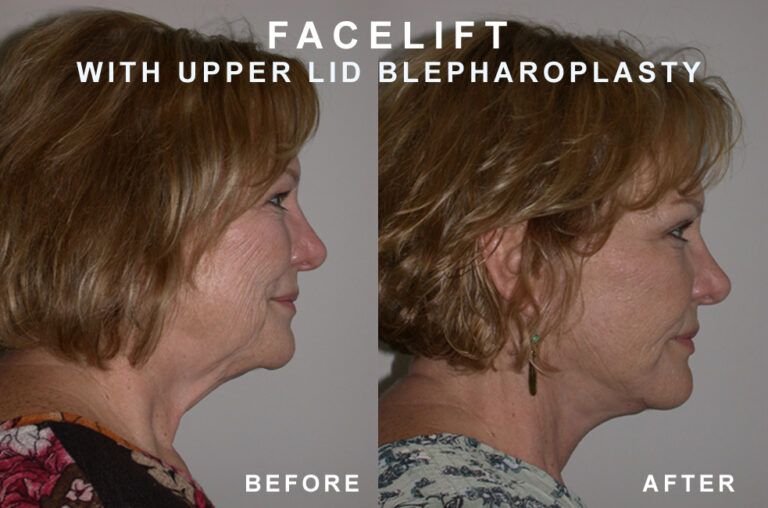 Side-by-side comparison of a woman's face before and after a facelift with upper eyelid blepharoplasty.