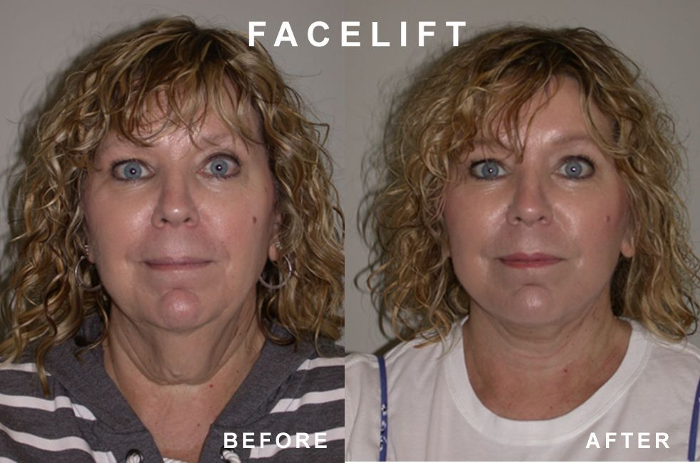 Before and after photos of a woman's face, showing a facelift. The 