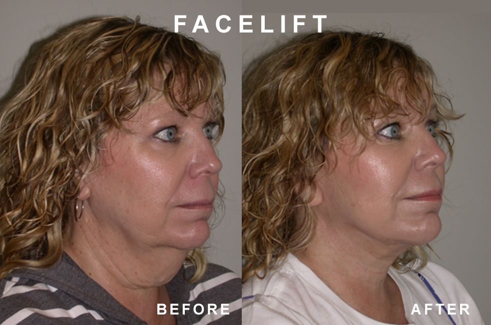 Comparison of a woman's face before and after a facelift.  The 
