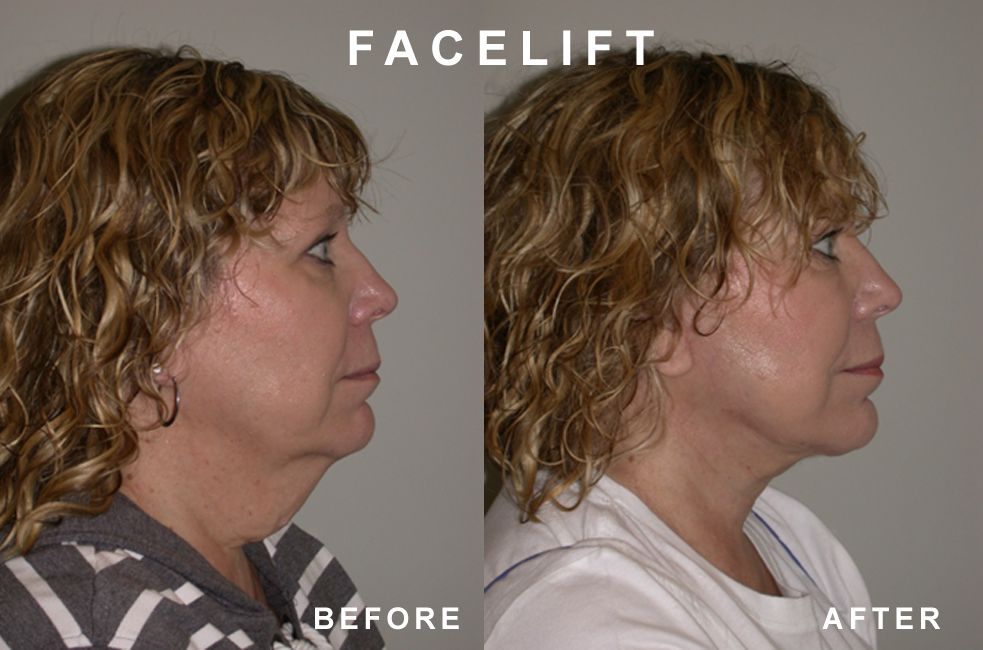 Facelift comparison: woman's profile before and after surgery. Skin tighter, neck improved.