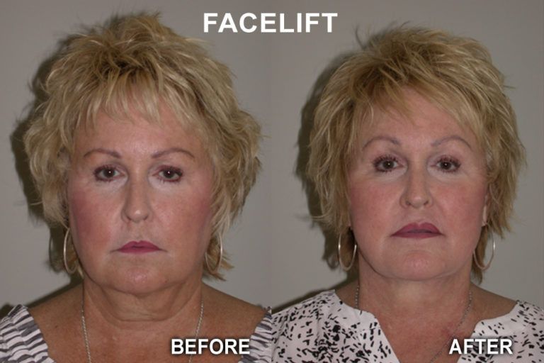 Side-by-side comparison: woman's face before and after a facelift. Skin is smoother, less wrinkled after.