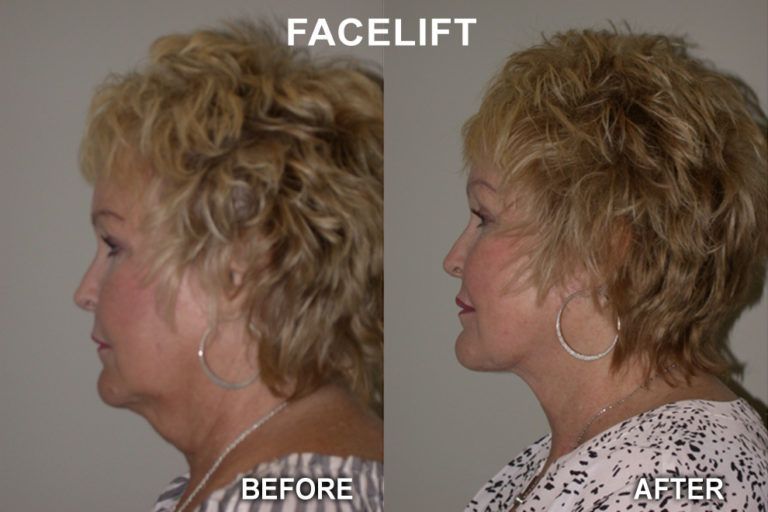 Side-by-side comparison of a woman's profile: before and after a facelift.  The 