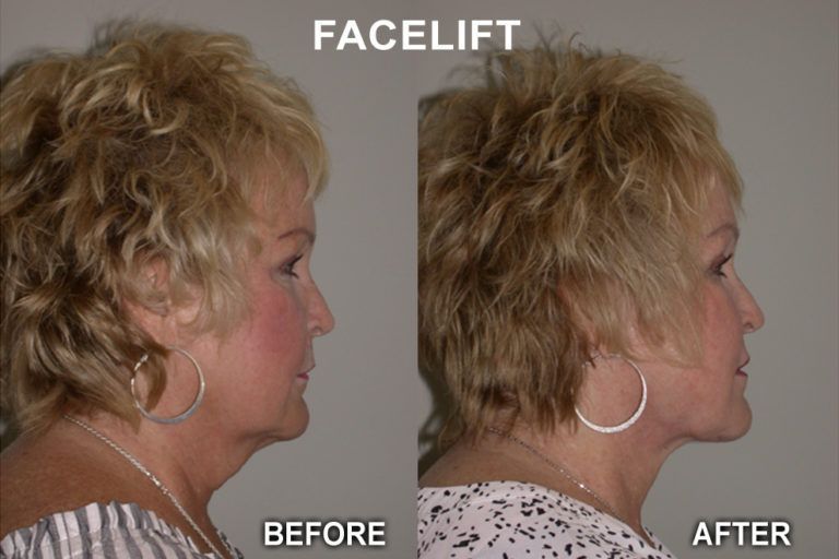 Facelift before and after comparison: Woman's profile with visible neck sagging is smoother and tighter after surgery.
