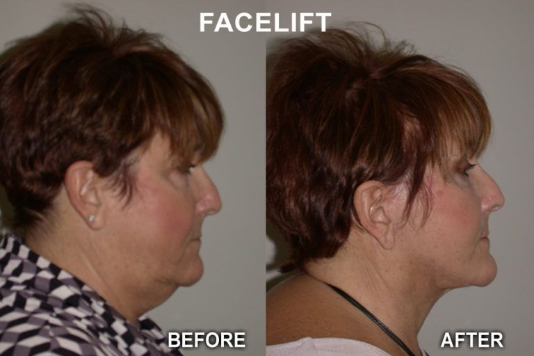 Before and after profile views of a woman's face, showing a facelift's effect on neck and jowls.