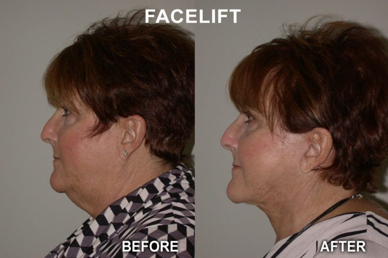 Before and after profile views, demonstrating a facelift's effect on the neck and jawline.