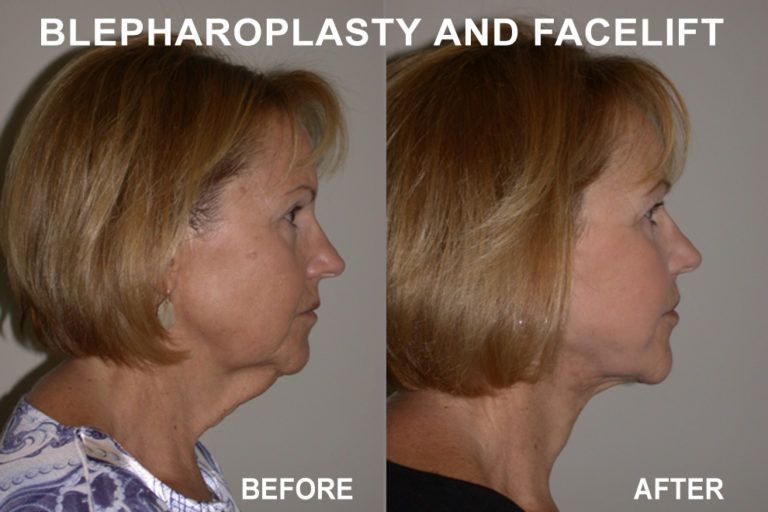 Side-by-side comparison of a woman's profile before and after blepharoplasty and facelift surgery, showing reduced wrinkles.