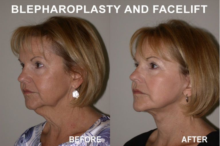 Blepharoplasty and facelift before and after. Woman's profile shows reduced neck sagging and eye bag removal.