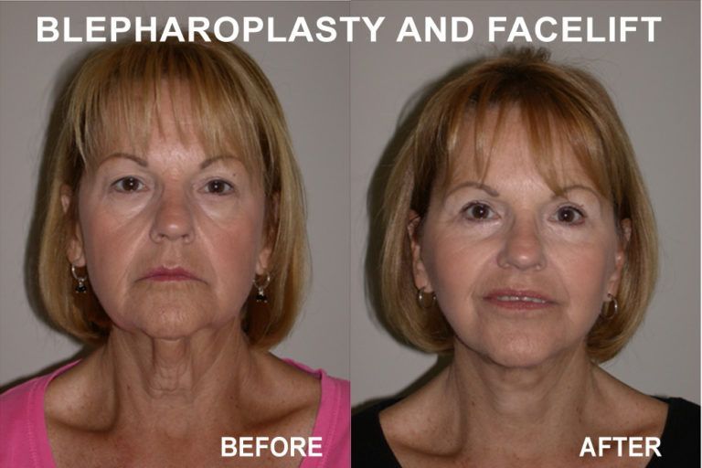 Before and after photos showing a woman with drooping eyelids and neck, after a blepharoplasty and facelift.