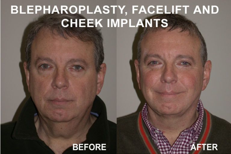 Before-and-after facial surgery comparison: man with wrinkles before, smoother skin after blepharoplasty, facelift, cheek implants.
