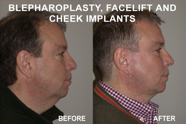Side-by-side view of a man's face before and after blepharoplasty, facelift, and cheek implants; changes in neck and cheek definition.