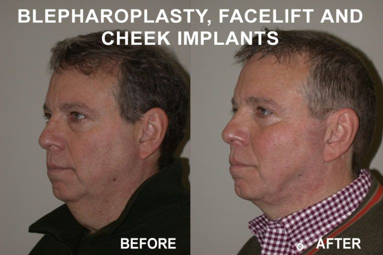 Before and after side profile of a man's face; shows results of blepharoplasty, facelift and cheek implants.