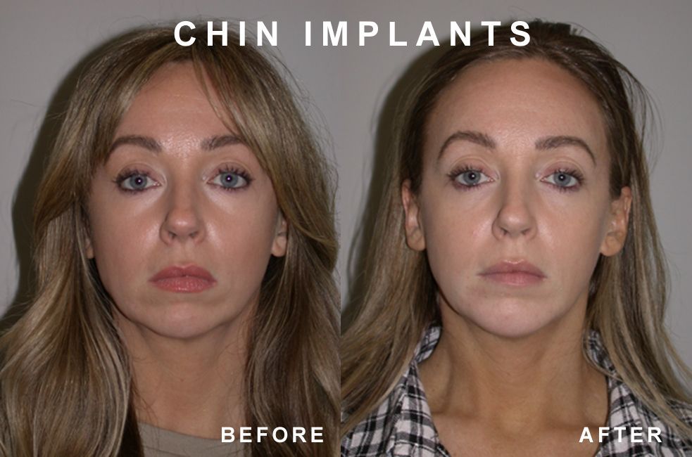 Comparison of a woman's face before and after chin implants. The 