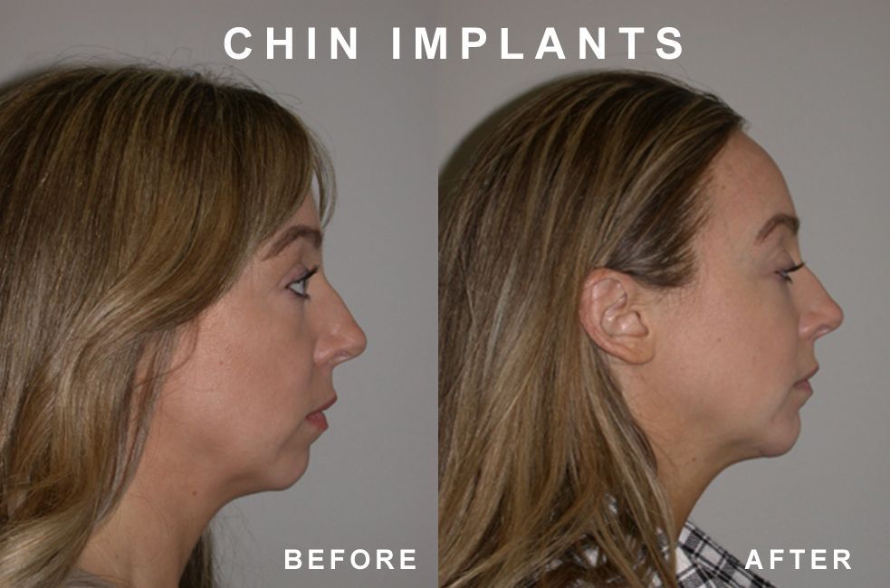Profile views: before/after chin implant. Increased chin projection. Blonde hair. Neutral background.