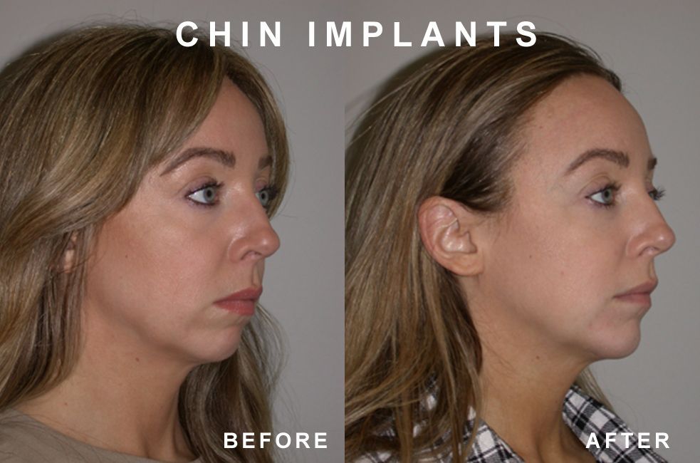 Comparison of a woman's face before and after chin implants. The 