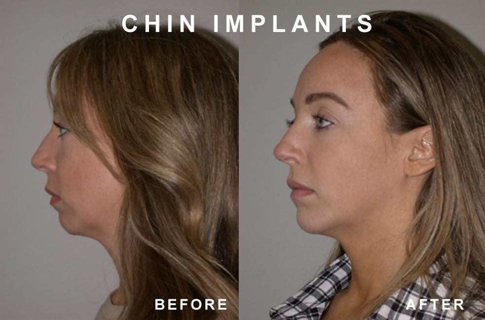 Comparison of two women's profiles, before and after chin implants; faces, necks, light skin, indoor setting.