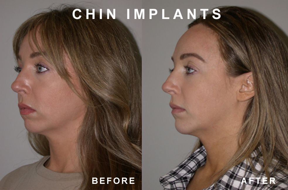 Side-by-side comparison of a person's profile: before and after chin implants.