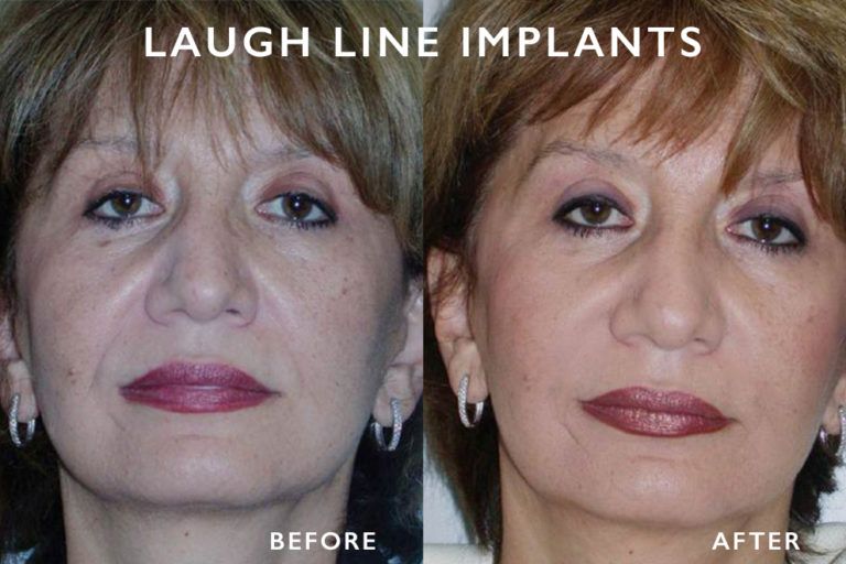 Comparison photo: woman before and after laugh line implants; reduced lines, smoother skin.