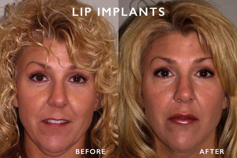 Comparison of a woman's face before and after lip implants; before shows thin lips, after shows fuller lips.