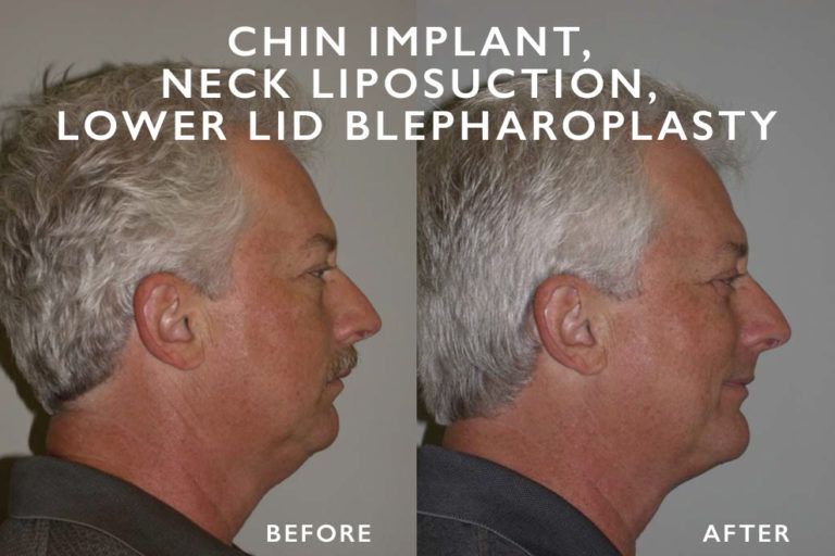 Before and after profile views of a man's face and neck, showcasing cosmetic surgery results.