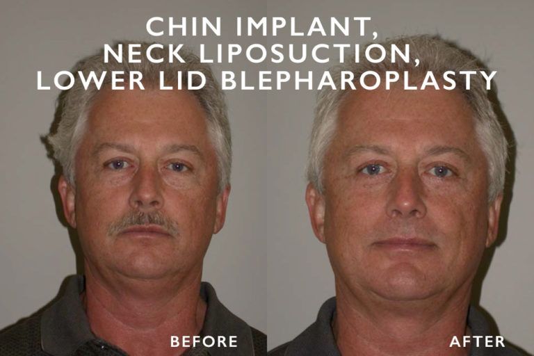 Side-by-side comparison: man before and after chin implant, neck liposuction, and lower lid blepharoplasty.