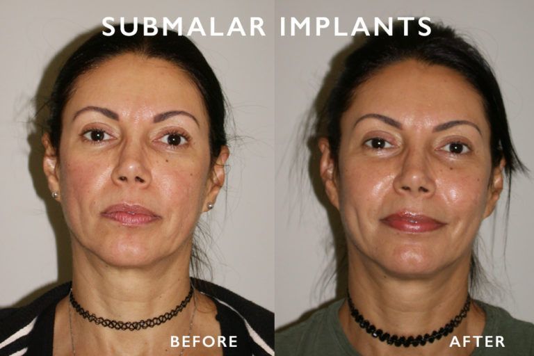 Before-and-after of a woman’s face, showing fuller cheeks after submalar implants.