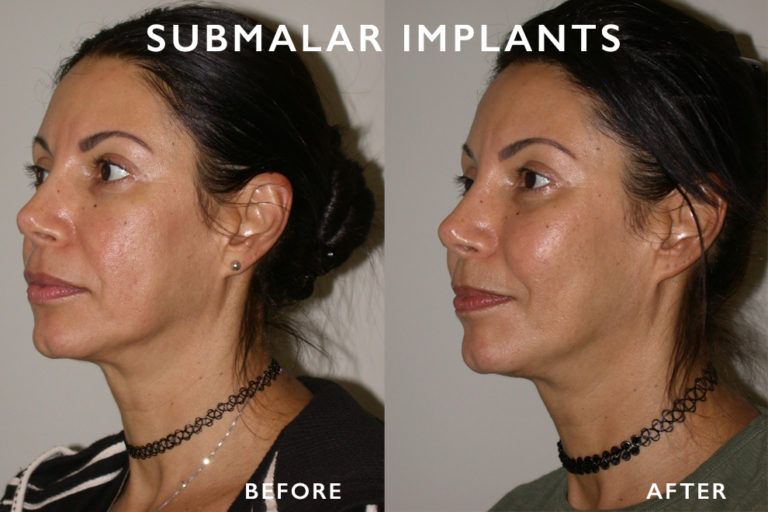 Side-by-side comparison shows a woman's face before and after submalar implants. The 