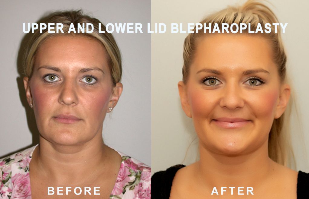 Side-by-side photo shows a woman's face before and after upper and lower eyelid blepharoplasty. 