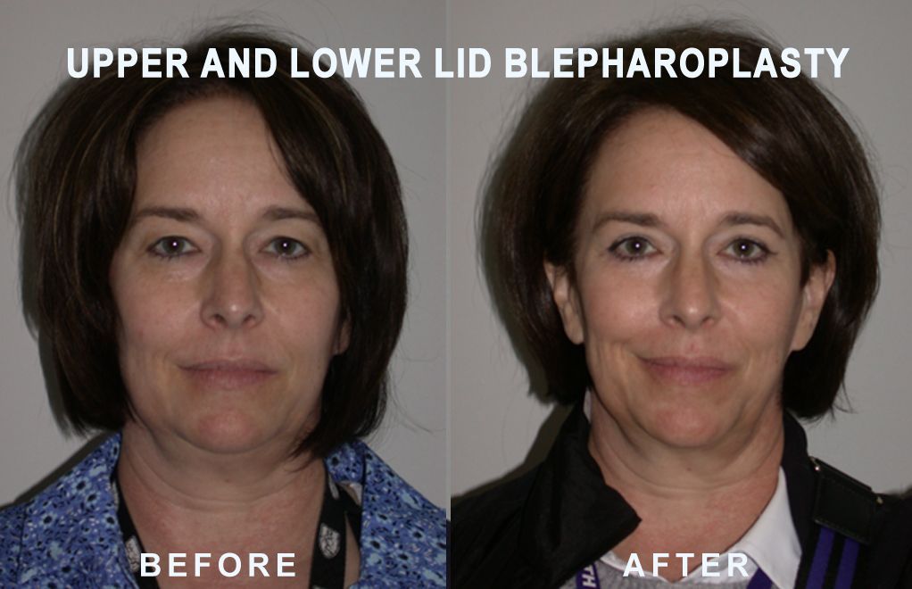 Comparison: woman's face before and after upper/lower eyelid surgery. Left: hooded eyes, right: eyes more open.