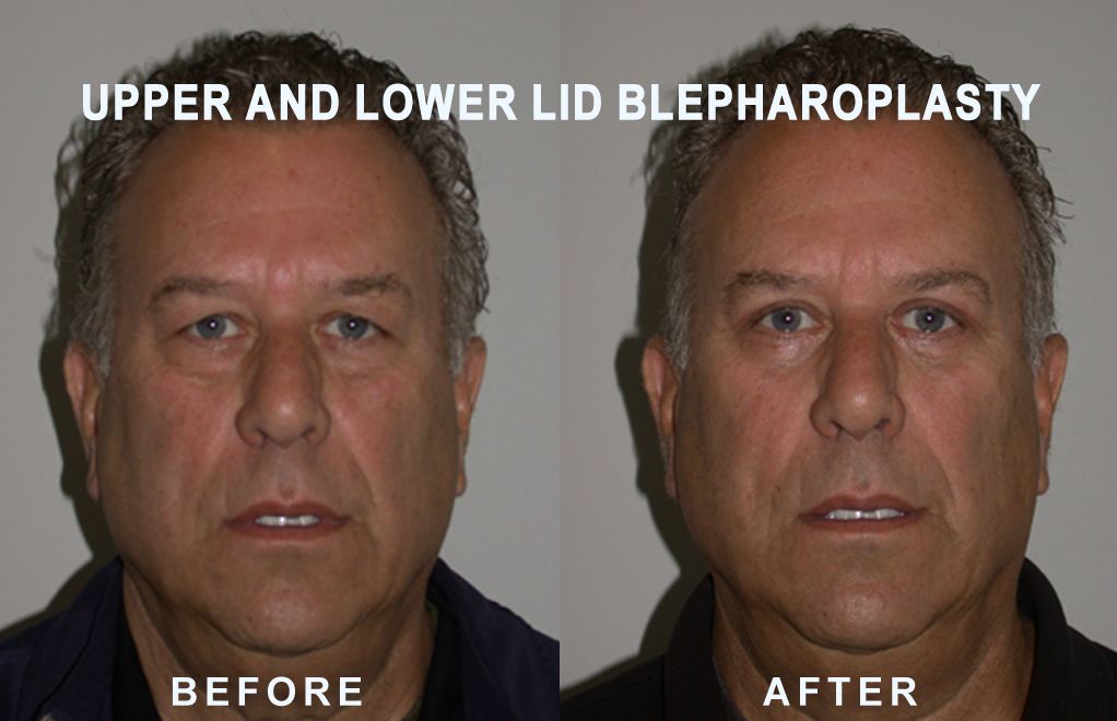 Side-by-side comparison of a man's face: 