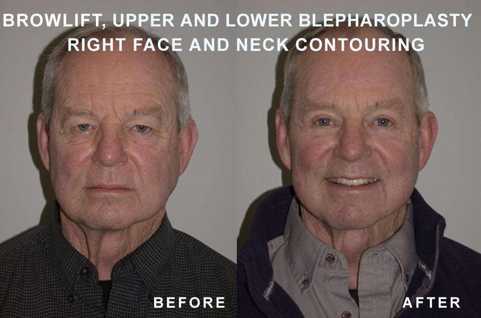 Before-and-after of a man's face after browlift, blepharoplasty, and face/neck contouring; smiling after surgery.