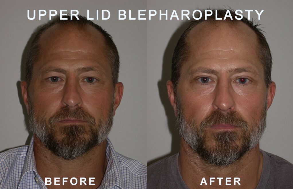 Before-and-after photos of a man's upper eyelids, showing the effects of a blepharoplasty.