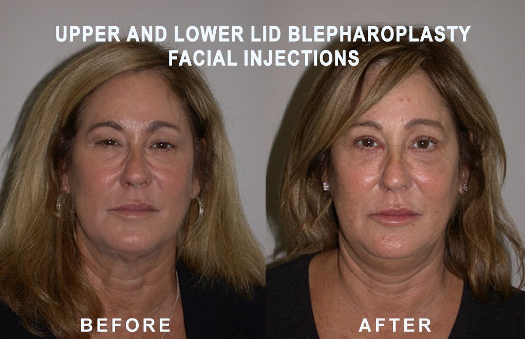 Before and after photos of a person's face after eyelid surgery and facial injections.