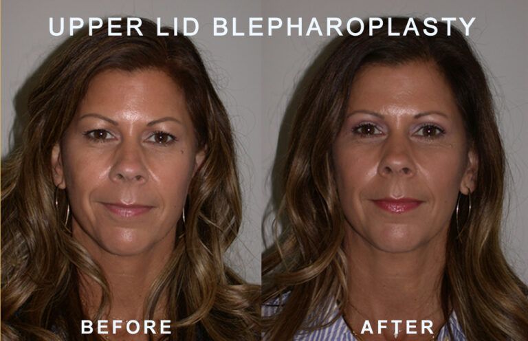 Before and after photos of a woman's eyes after upper eyelid blepharoplasty, showing reduced lid droop.