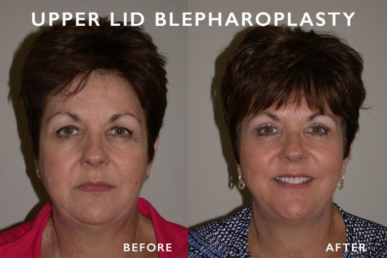 Side-by-side photos of a woman's face: before and after upper eyelid blepharoplasty, showing lifted eyelids and a more alert appearance.