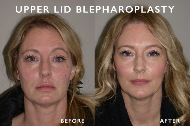 Before and after photos of a woman's face, demonstrating the effects of an upper eyelid blepharoplasty.