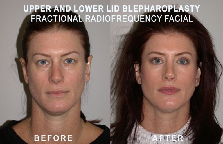 Before and after facial photo: Upper/lower eyelid blepharoplasty, fractional radiofrequency facial. Smoother skin and less eyelid droop.