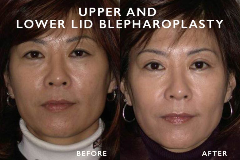 Before and after photos showing results of upper and lower eyelid blepharoplasty.