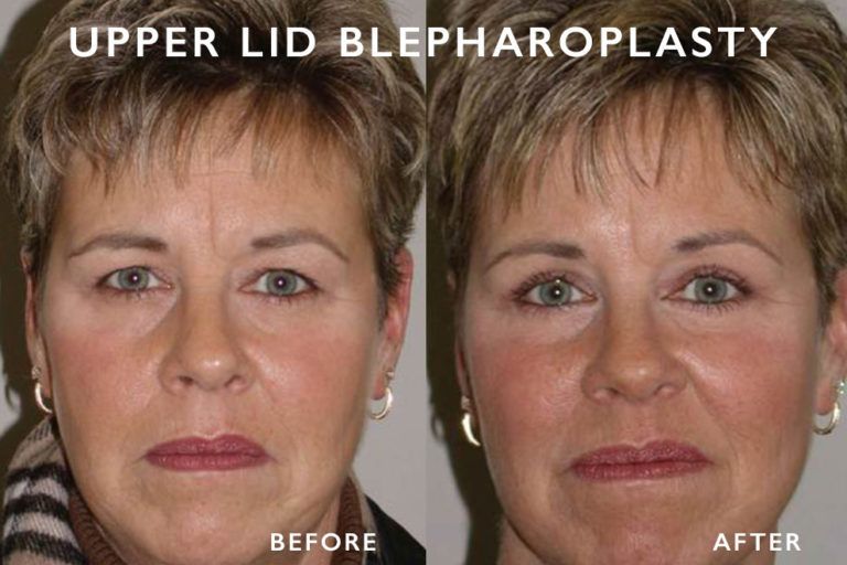 Before and after photos of a woman's upper eyelids, showing the results of a blepharoplasty.