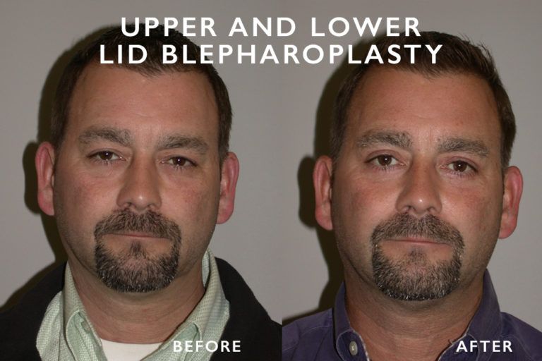 Before and after photos of a man's face after upper and lower eyelid surgery, showing reduced droopiness.